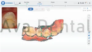 اسکنر شاینینگ مدل lync شامل نشانگر کیفیت اسکن می باشد که بخش های با داده ناکافی را به رنگ خاسکتری نشان میدهد