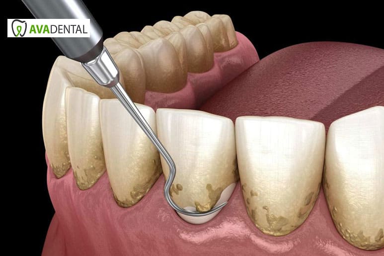جدیدترین روش های جرم گیری دندان چیست؟