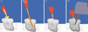 abturator and tooth canal