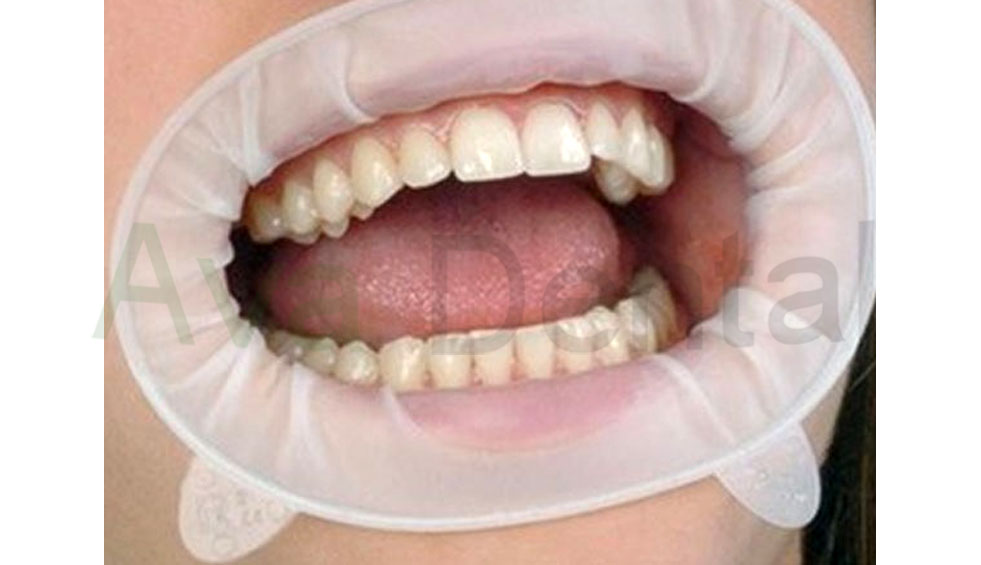 قیمت دهان باز کن دندانپزشکی OptraGate | آوادنتال