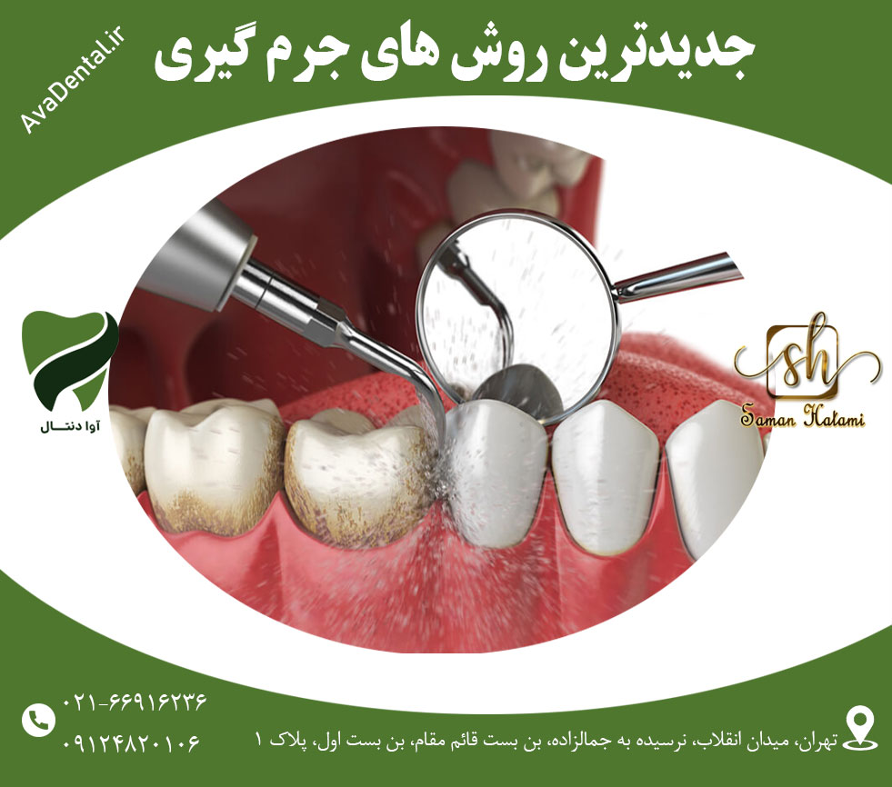 جرمگیری دندان - جدیدترین روش های جرم گیری | آوادنتال