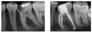tooth root picture