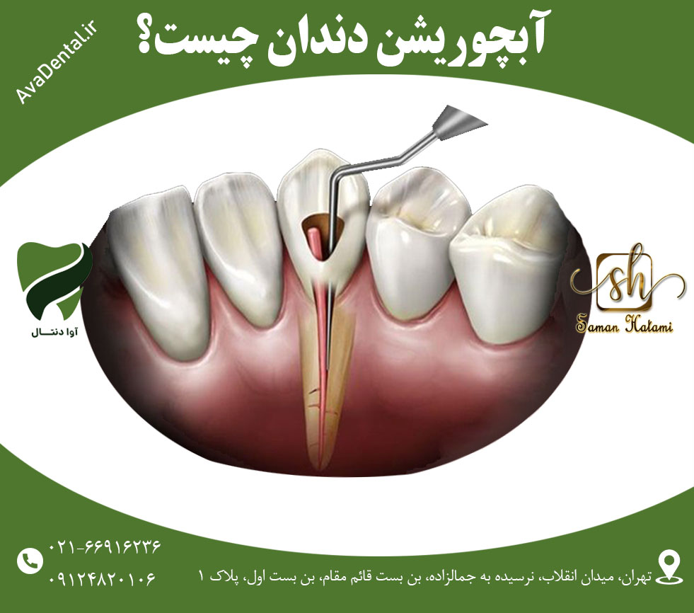 آبچوریشن دندان چیست؟ 1 آبچوریشن دندان چیست؟ | آوادنتال