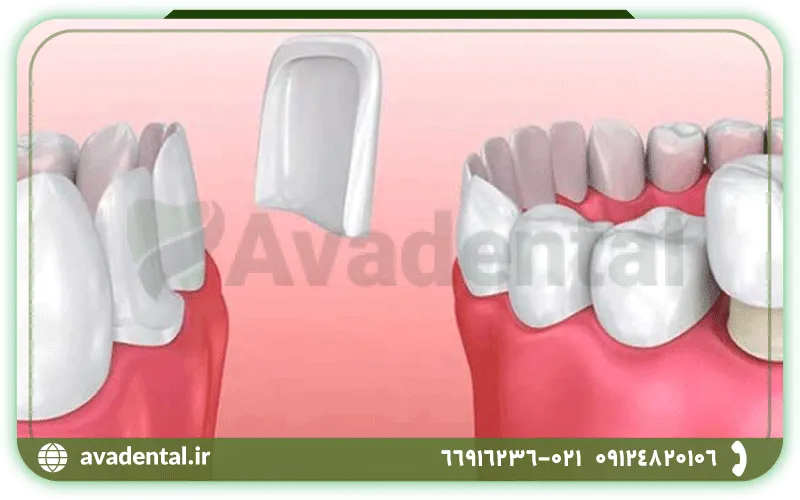 تفاوت کامپوزیت دندان با لمینت دندان