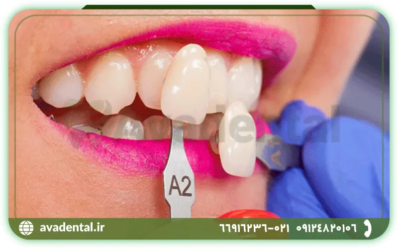 عوارض کامپوزیت دندان های جلو چیست