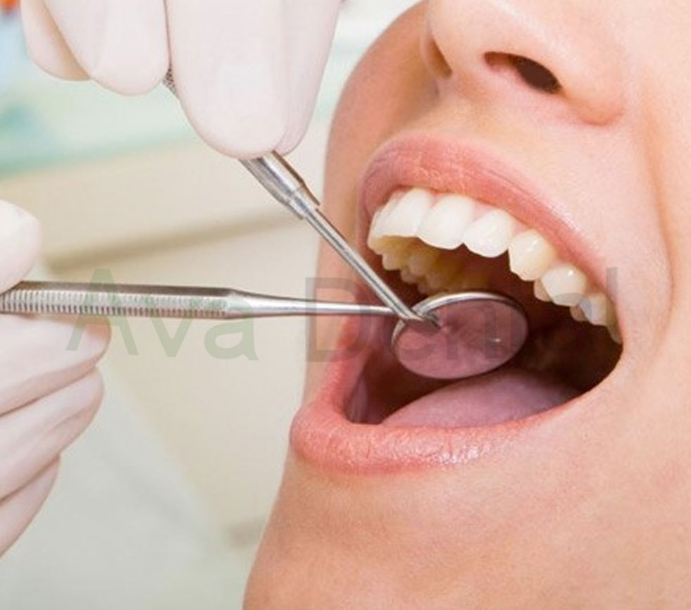 آینه دندانپزشکی دنا پویا 12 عددی | آوادنتال