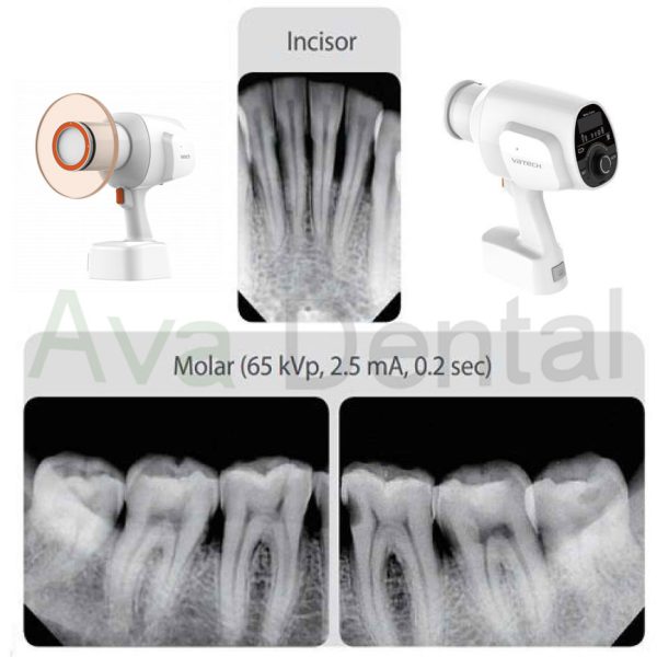 کیفیت عکس رادیوگرافی پرتابل واتک Vatech | آوادنتال