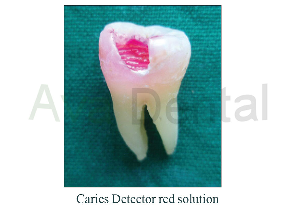 محلول تشخیص پوسیدگی دندان | آوادنتال