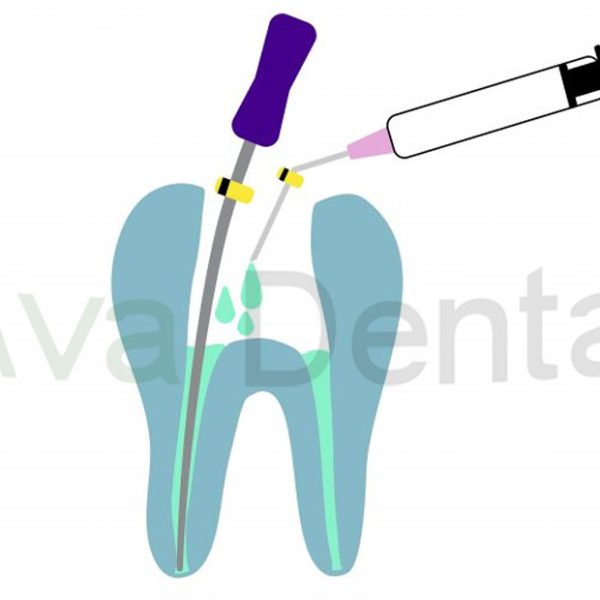 نحوه استفاده محلول هیپوکلریت سدیم 5.25% HypoEndox | آوادنتال