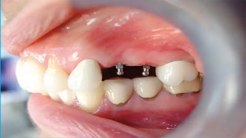 مزیت های استفاده از مینی ایمپلنت دندان چیست؟