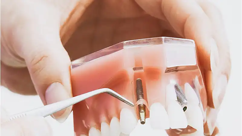 معایب استفاده از مینی ایمپلنت دندان چیست؟
