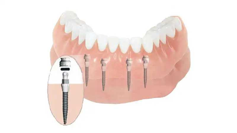 مینی ایمپلنت دندان چیست؟