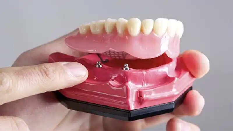 کاربرد مینی ایمپلنت دندان چیست؟