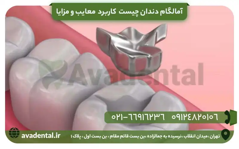 آمالگام دندان چیست؟ کاربرد + معایب و مزایا 1 آمالگام دندان چیست؟ کاربرد + معایب و مزایا