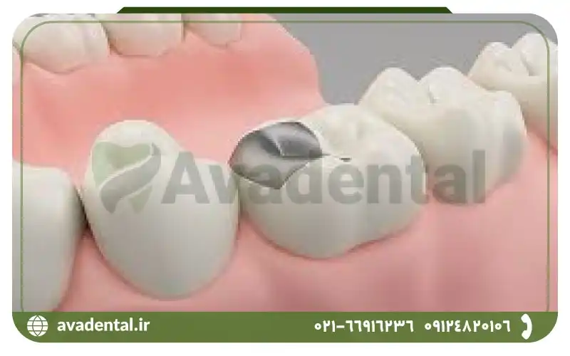 آمالگام دندان چیست؟