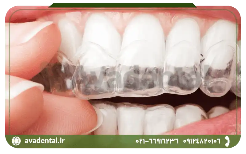 بلیچینگ دندان در خانه و مطب چگونه انجام می شود؟