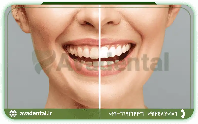 تفاوت کامپوزیت و بلیچینگ دندان