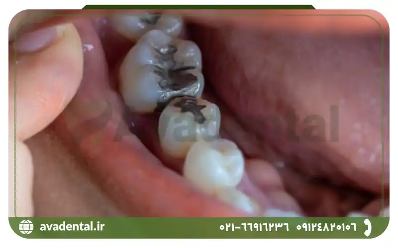 معایب آمالگام دندان چیست؟