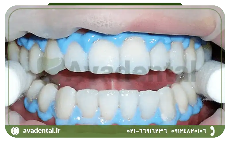 معایب بلیچینگ دندان چیست؟