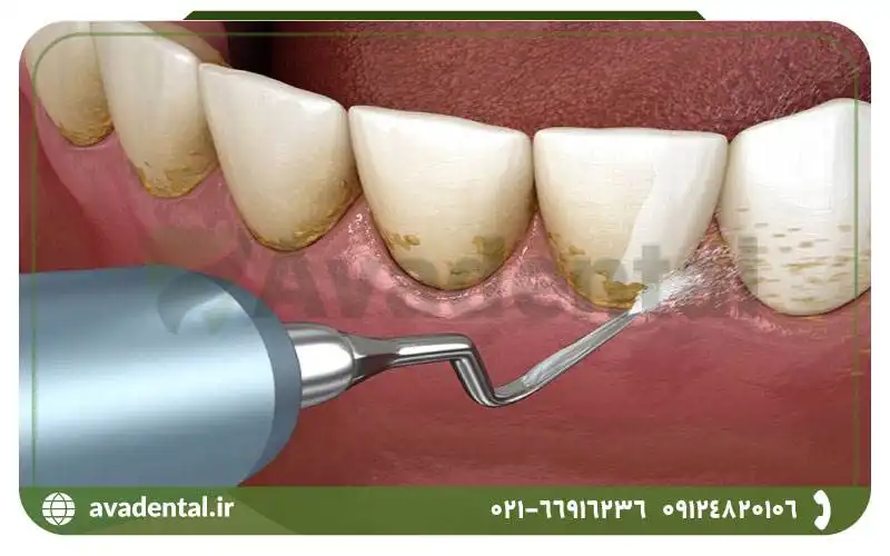 معایت ایرفلو دندانپزشکی چیست؟