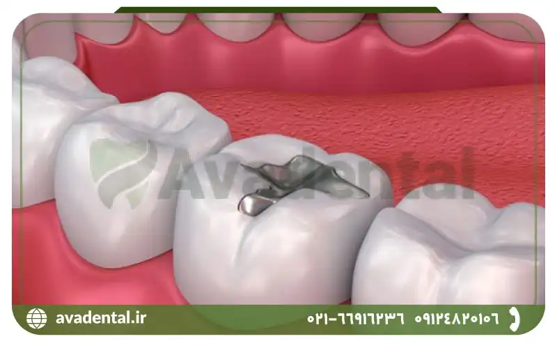 مواد تشکیل دهنده آمالگام دندان چیست؟