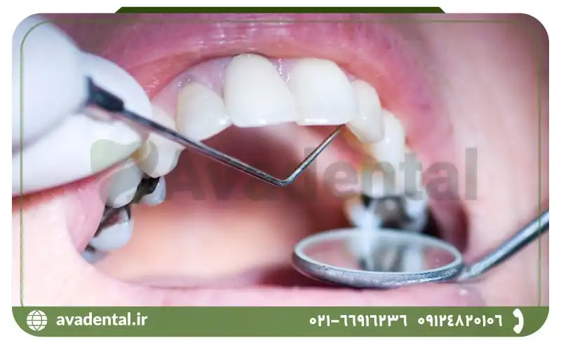 کاربرد های آمالگام دندان چیست؟