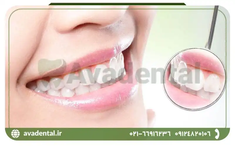 کاربردهای ایرفلو دندانپزشکی چیست؟