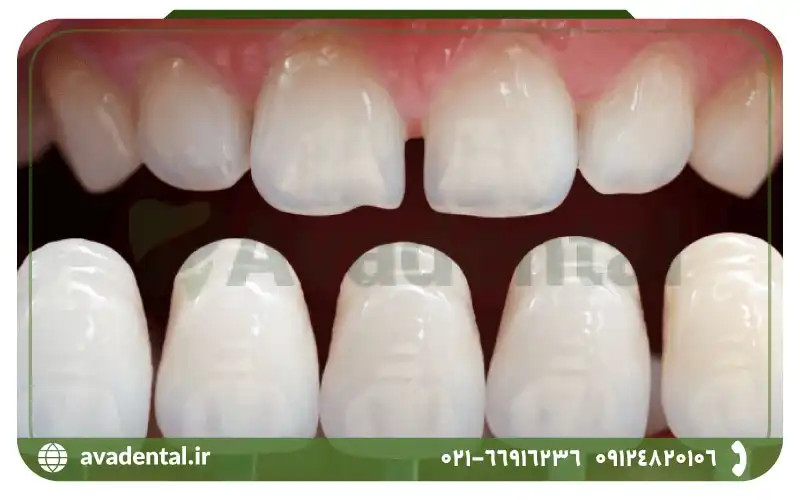 تفاوت کلی کامپوزیت، لمینیت دندان و بلیچینگ چیست؟
