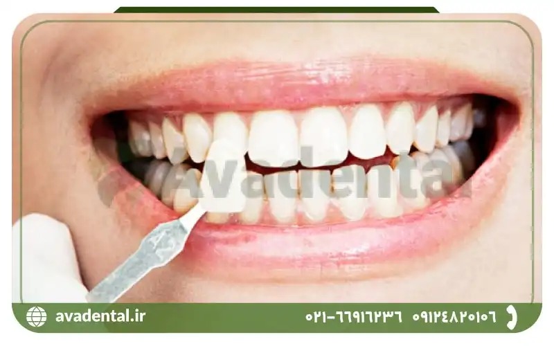 عوارض و معایب کامپوزیت دندان چیست؟