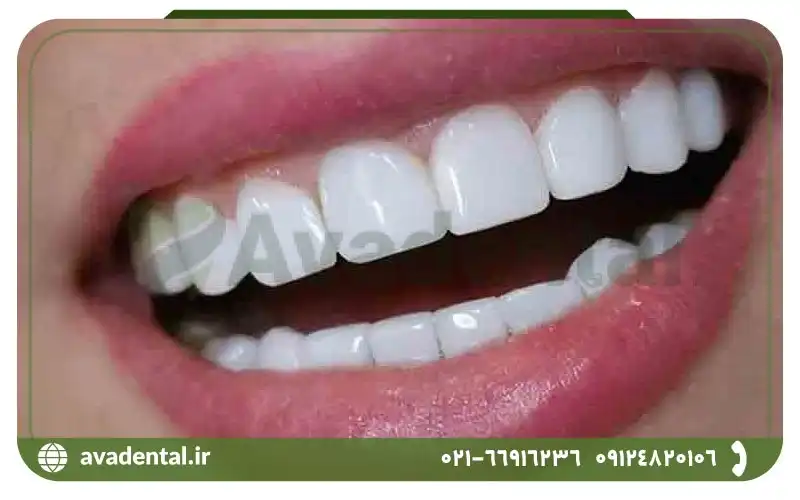 فواید و مزیت های استفاده از کامپوزیت دندان چیست؟