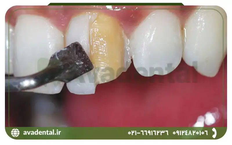 مواد تشکیل دهنده کامپوزیت دندان