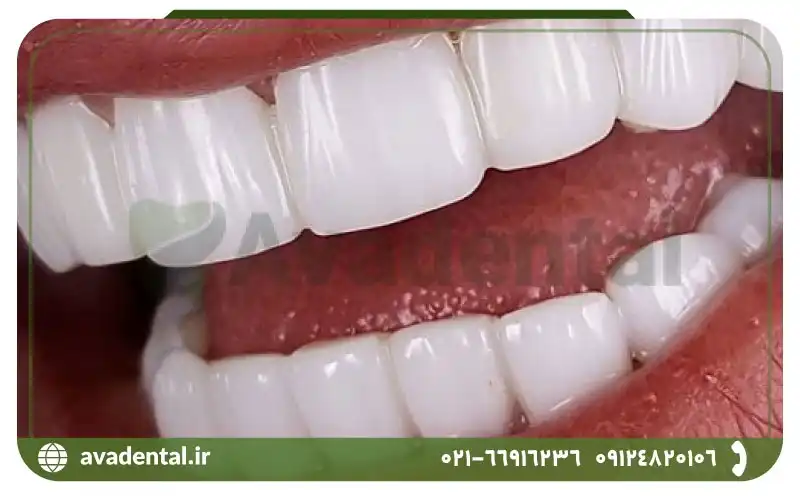چرا از کامپوزیت و لمینت دندان و بلیچینگ دندان استفاده می شود؟