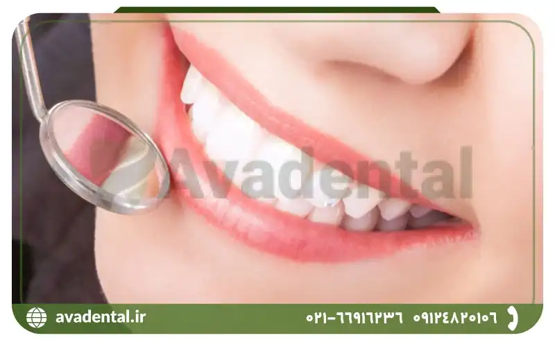 کاربردهای کامپوزیت دندان چیست؟