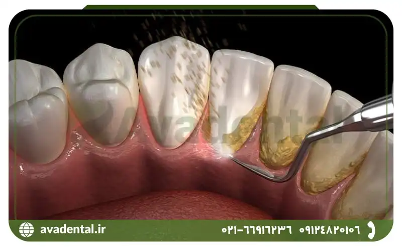 فرق بلیچینگ با جرم گیری دندان در چیست؟