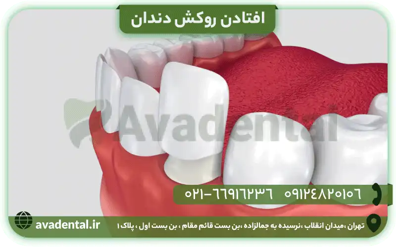 افتادن روکش دندان