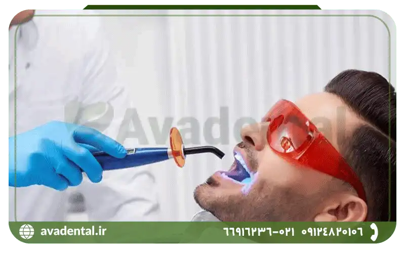 انواع لایت کیور دندانپزشکی