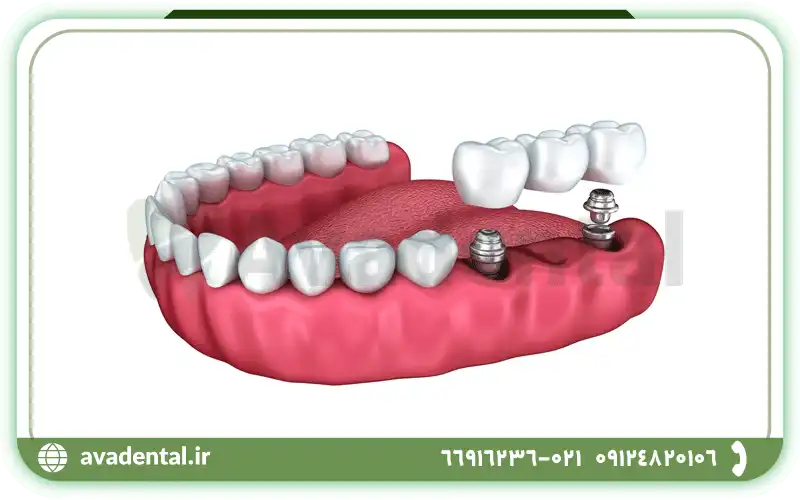 روش بریج یکی از انواع کاشت دندان