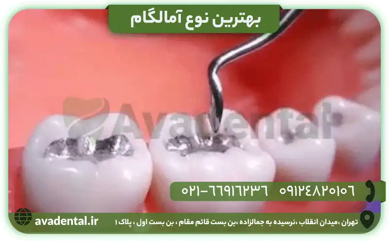 بهترین نوع آمالگام