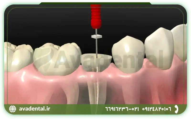 درمان ریشه دندان یا عصب کشی چطور انجام می شود؟