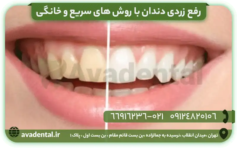 رفع زردی دندان