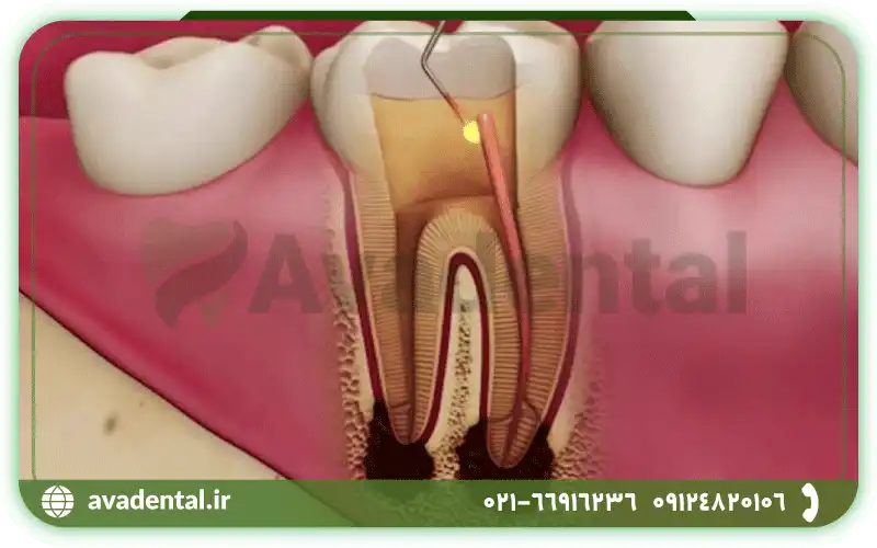 ریشه دندان چیست و چه تفاوتی با کانال دارد؟