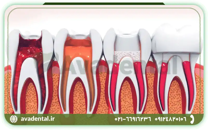 تفاوت ریشه و کانال دندان در ساختار و ساختمان آن ها