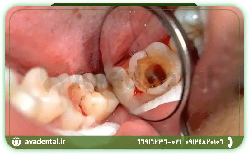 علائم عفونت و پوسیدگی پالپ دندان