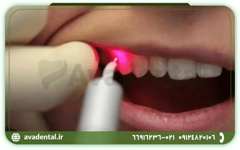 بهره بردن از لیزر برای بلیچینگ دندان