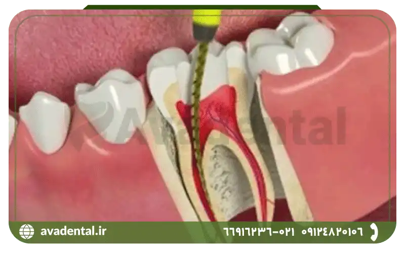 مزایا و معایب اندو دندان چیست؟