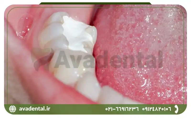 مزایای تمپ یا کویت دندانپزشکی