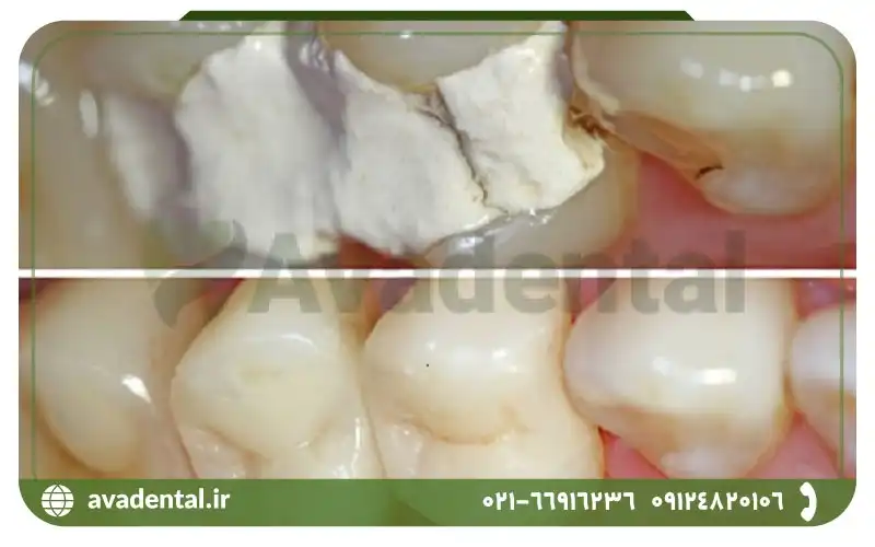 مواردی که در طول استفاده از کویت(پانسمان موقت) در دندان باید رعایت کنید
