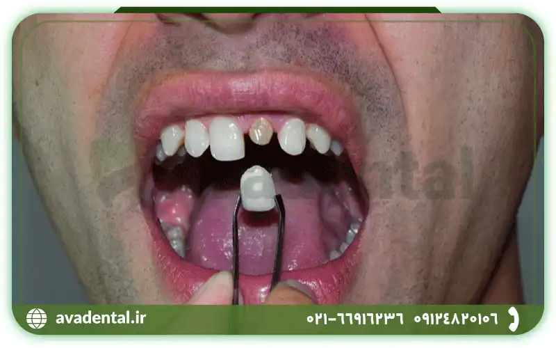 علت های افتادن روکش دندان چیست؟
