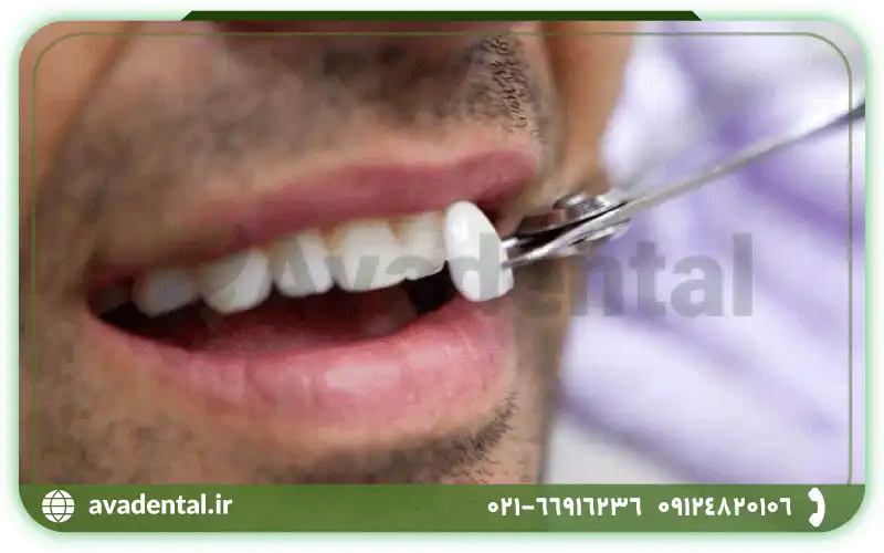آسیب به روکش دندان در اثر خوردن غذاهای سفت و سخت و افتادن روکش دندان