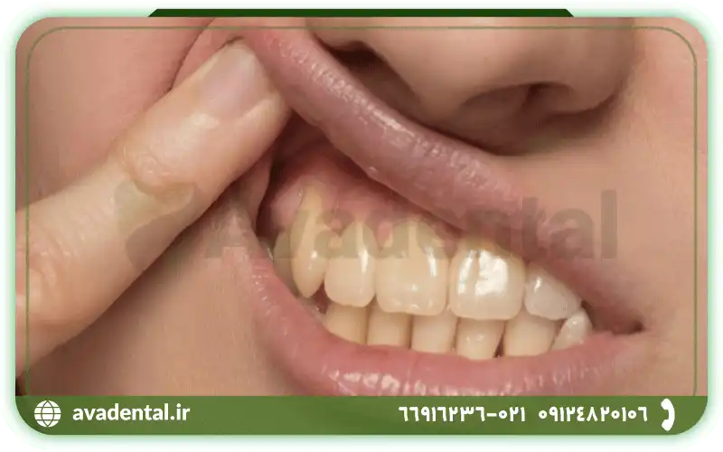 استفاده از جوش شیرین و پراکسید هیدروژن برای رفع زردی دندان